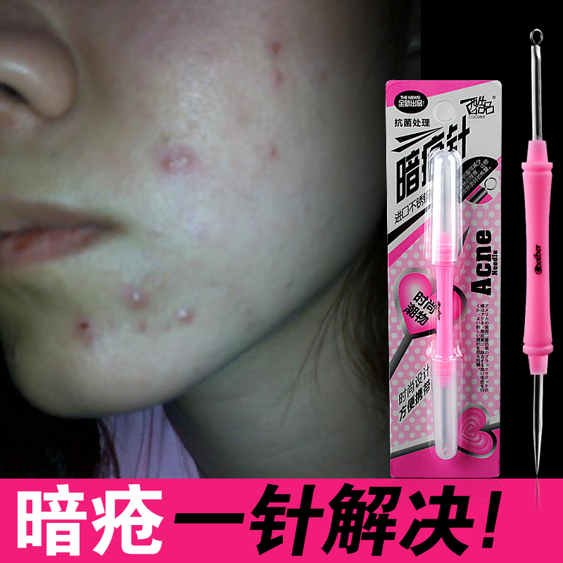 粉刺针怎么去黑头_粉刺针3步祛痘步骤和痘痘说再见 ...
