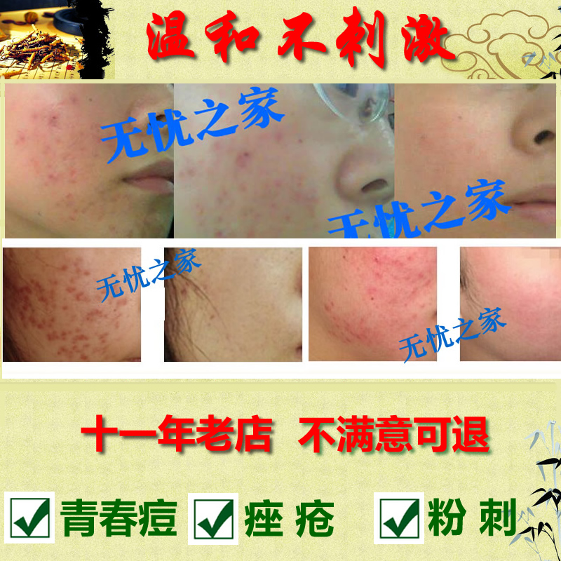 无忧之家 11年老店 祛青春痘/痤疮/毛囊炎 喷剂 无刺激|ruв категории животное/Животное питание и принадлежностей, кошка/собака красоты уборки, Другие красоты уборки - от Buy2taobao.com для оказания профессиональной услуги покупки агента Taobao