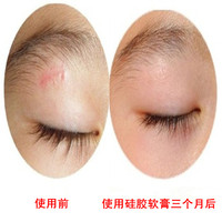 韩国丽卡祛疤组合\/去疤痕凹凸手术\/烫伤疤破腹