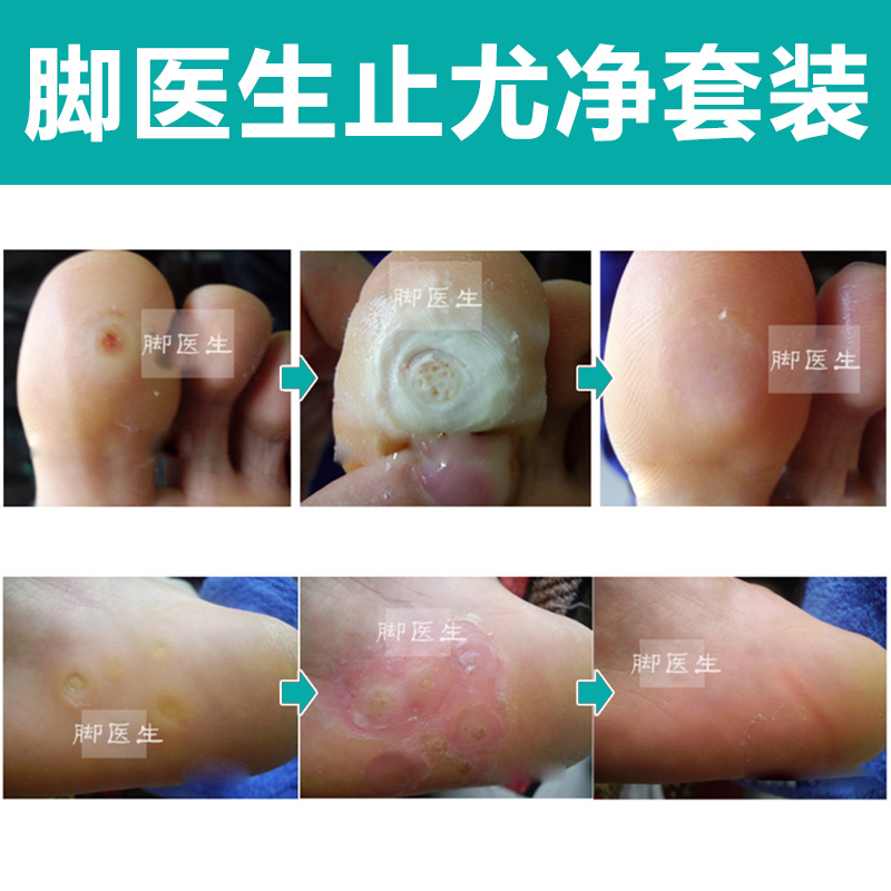 脚医生跖疣膏去除脚底日本手足部疣必治鸡眼瘊子肉刺止尤净去疣灵在类目 本地化生活服务, 健康服务, 足浴/洗浴/按摩中 - 来自Buy2taobao.com提供专业的淘宝代购服务