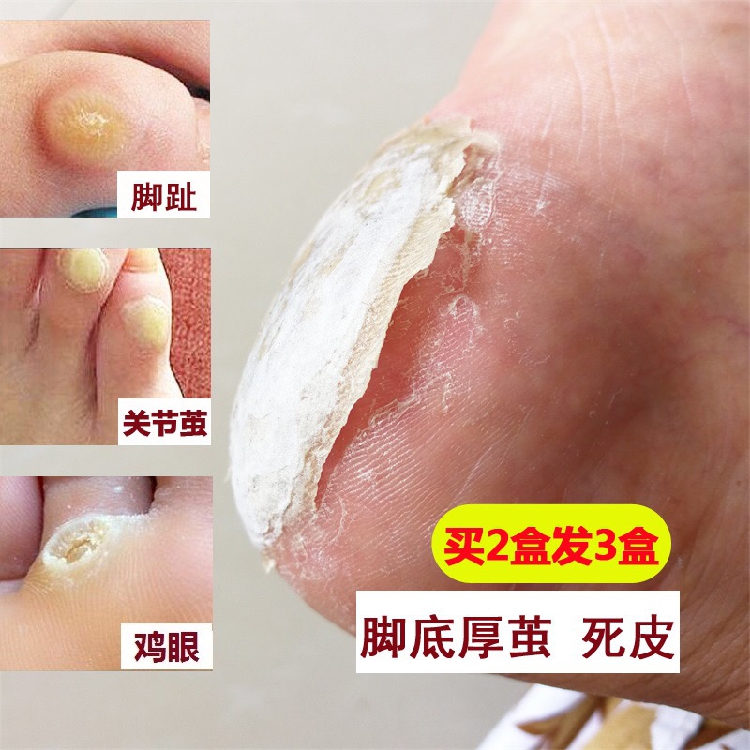 去除鸡眼脚丁专用贴老茧药膏治肉刺脚茧子厚茧趾茧脚垫在类目 本地化生活服务, 健康服务, 足浴/洗浴/按摩中 - 来自Buy2taobao.com提供专业的淘宝代购服务
