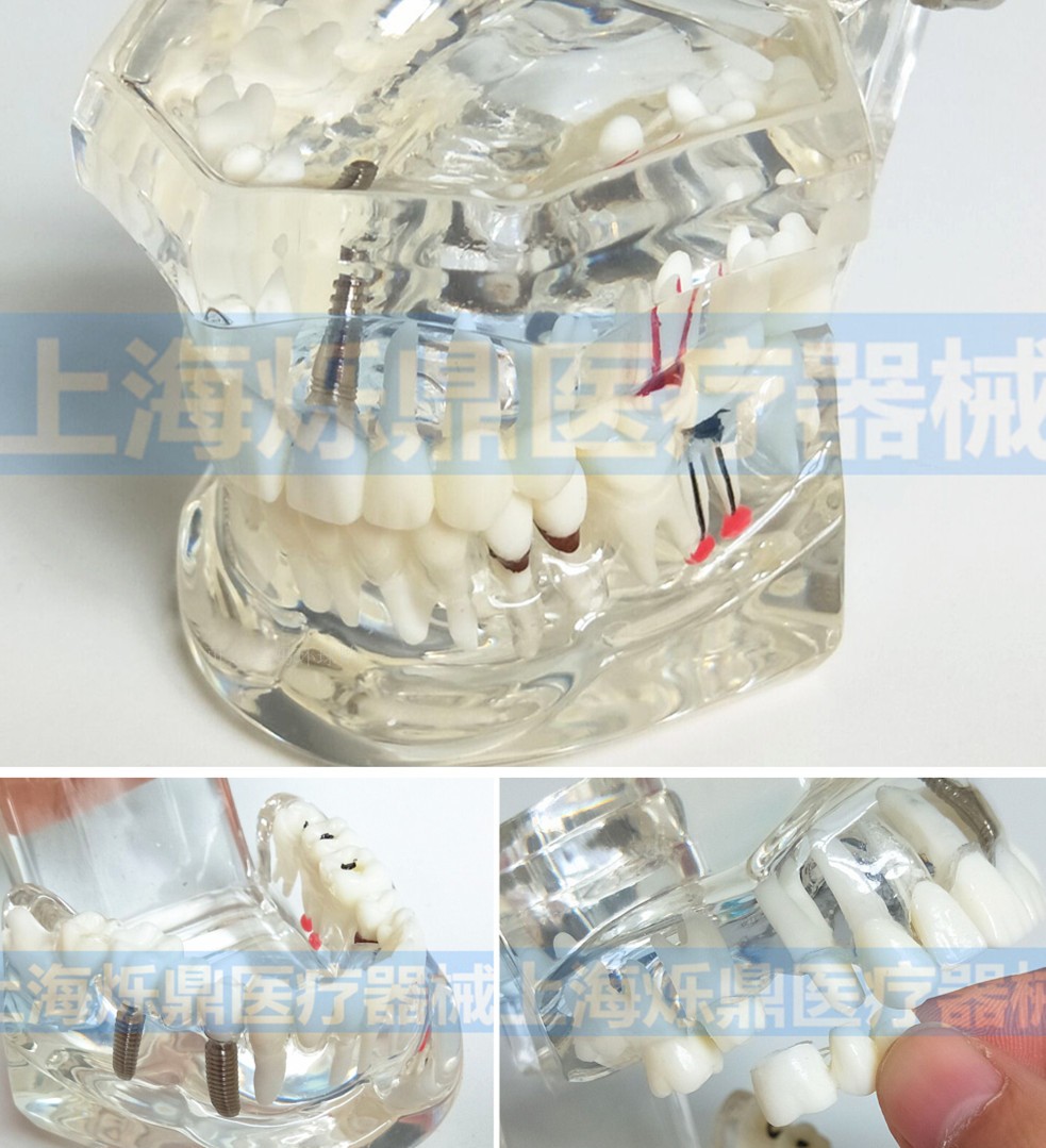 Stomatology Department repair comprehensive Pathology repair Model transparent plant Extraction Dental Patient communicate teachingin the Toy/Childs/Puzzle/Building block/Model , Static model , Other model toys category - from Buy2taobao.com to provide professional Taobao agent buy service