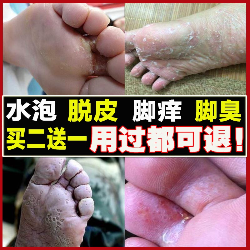 治療腳氣去根噴劑的藥膏癬止癢外用神器真菌感染脫皮臭腳出汗克星在類目 本地化生活服務, 健康服務, 足浴/洗浴/按摩中 - 來自Buy2taobao.com提供專業的淘寶代購服務