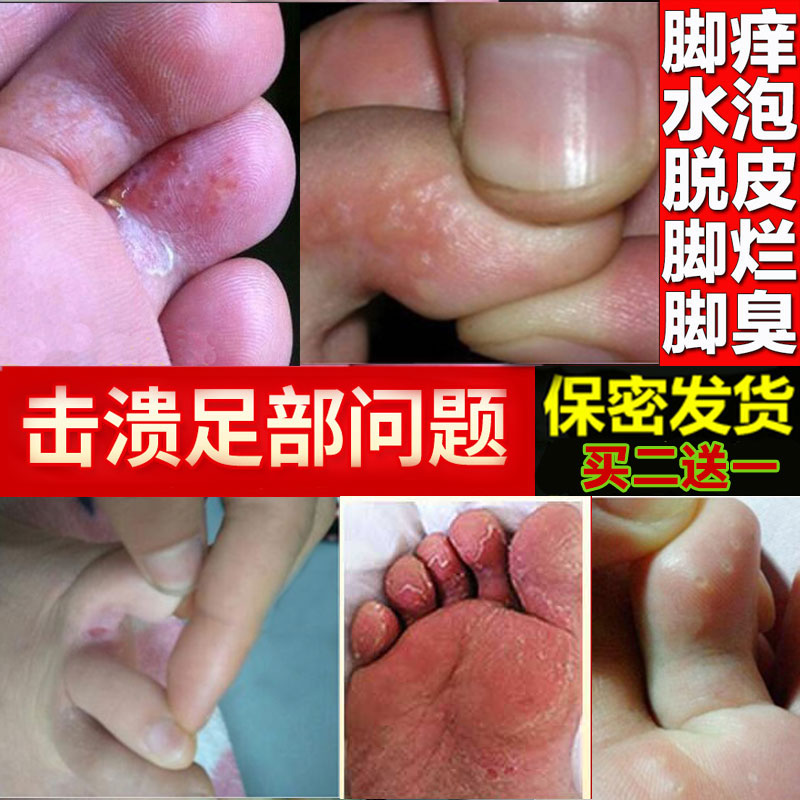 脚痒水泡脱皮烂脚丫杀菌止痒膏足藓脚臭脚气脚起水泡脚趾缝开裂烂在类目 OTC药品/医疗器械/计生用品, 保健用品, 皮肤消毒护理(消)中 - 来自Buy2taobao.com提供专业的淘宝代购服务