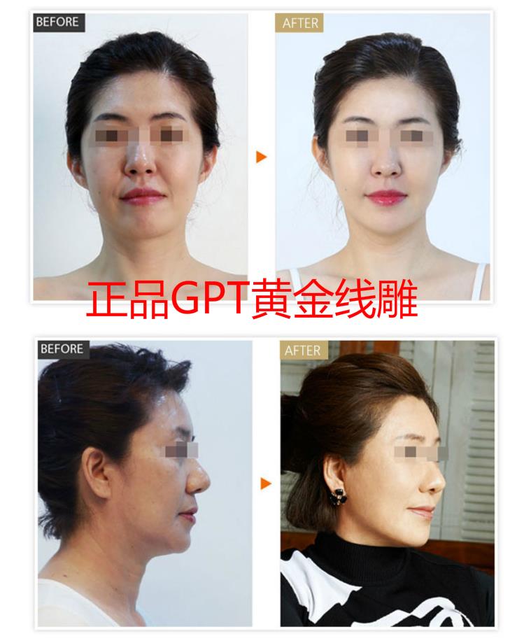 美容院專用套裝套盒蘋果肌原裝魚尾紋寇顏雅絲黃金線雕進口日本在類目 個人護理/保健/按摩器材, 清潔美容工具, 電子美容儀中 - 來自Buy2taobao.com提供專業的淘寶代購服務