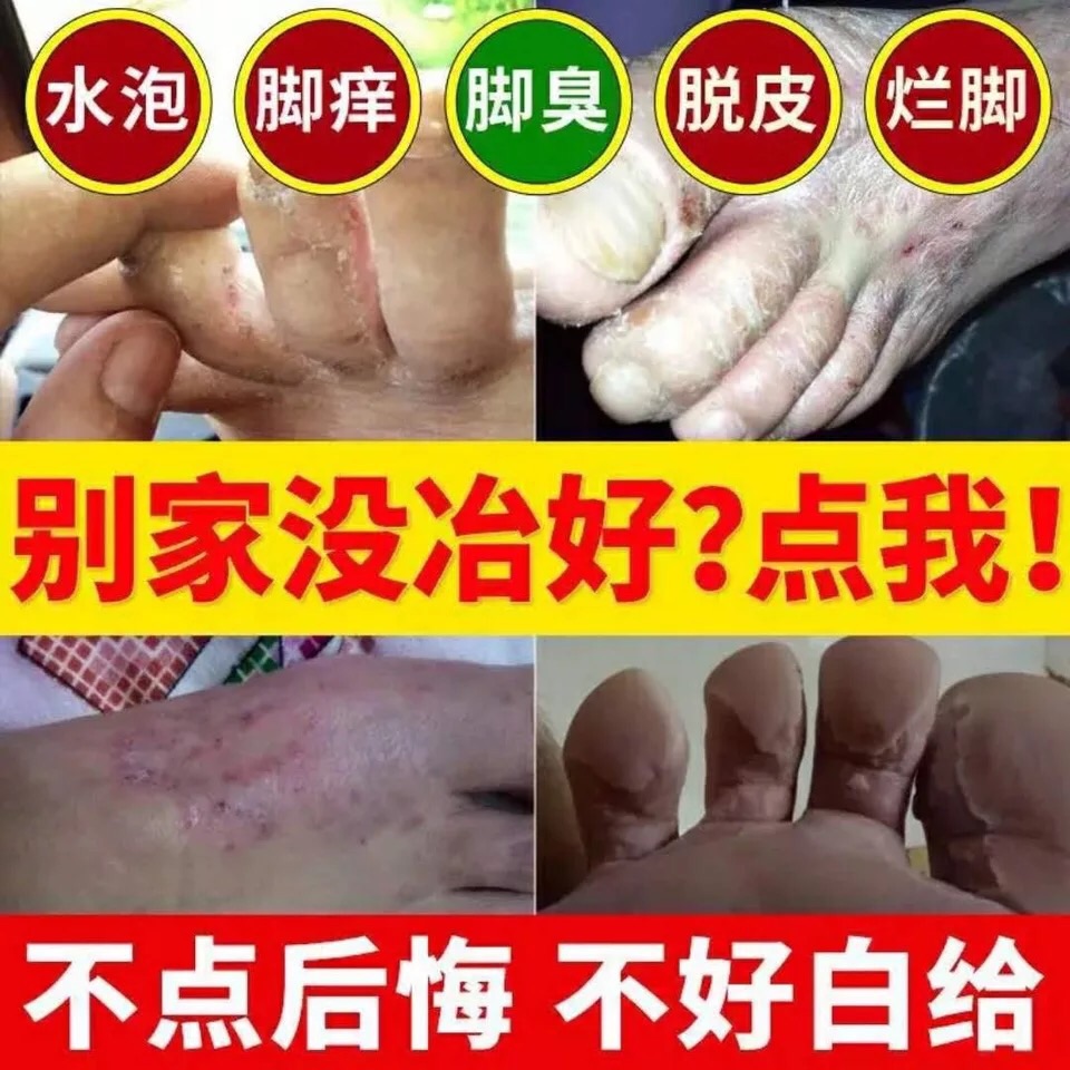 脚气药脚臭止痒脱皮水泡型真菌感染去根神器香港脚气泡脚粉喷雾膏在类目 本地化生活服务, 健康服务, 足浴/洗浴/按摩中 - 来自Buy2taobao.com提供专业的淘宝代购服务
