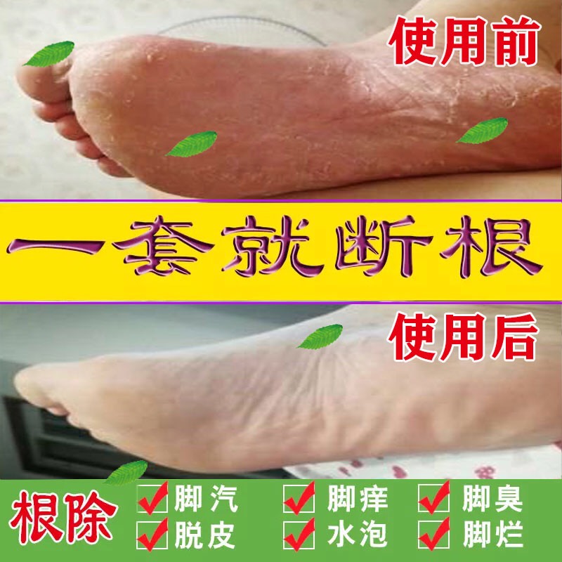 治疗花安乐喷剂止痒杀菌正品足爽脚臭脚出汗脚气泡脚药包去根神器在类目 本地化生活服务, 健康服务, 足浴/洗浴/按摩中 - 来自Buy2taobao.com提供专业的淘宝代购服务