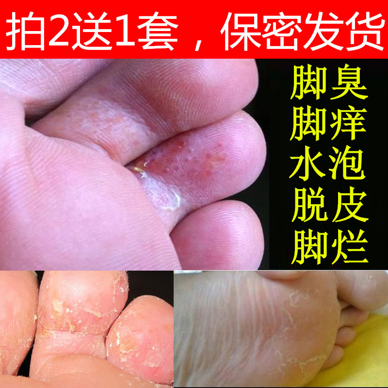 治腳氣噴劑祖簡大夫止癢脫皮殺菌去根的藥膏泡腳水除腳臭腳汗腳癢在類目 本地化生活服務, 健康服務, 足浴/洗浴/按摩中 - 來自Buy2taobao.com提供專業的淘寶代購服務