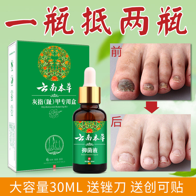 灰指甲液正品灰甲软甲膏灰趾甲软膏净灰甲去除增厚专用液清