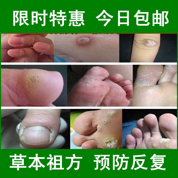 点刺猴子去肉刺祛去除手上长治脚上起去掉身上脖子鸡眼膏肉除根灵在类目 宠物/宠物食品及用品, 鸟类及用品, 医疗用品中 - 来自Buy2taobao.com提供专业的淘宝代购服务