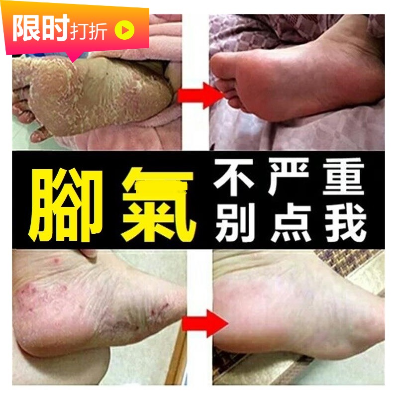 脚汗痒泡脚喷剂手气止痒脱皮脚干裂脚后跟气膏苗藓癣王套装喷剂膏|msdalam kategori Penyetempatan perkhidmatan kehidupan, Perkhidmatan kesihatan, kaki/Bath/urut - dari Buy2taobao.com untuk memberikan perkhidmatan ejen Taobao profesional membeli