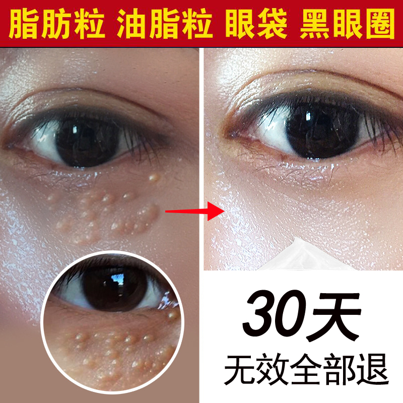 祛除脂肪粒快速去眼袋黑眼圈眼霜精華膏油脂粒眼面部護理神器男女在類目 美容護膚/美體/精油, 眼部護理(新), 眼霜中 - 來自Buy2taobao.com提供專業的淘寶代購服務