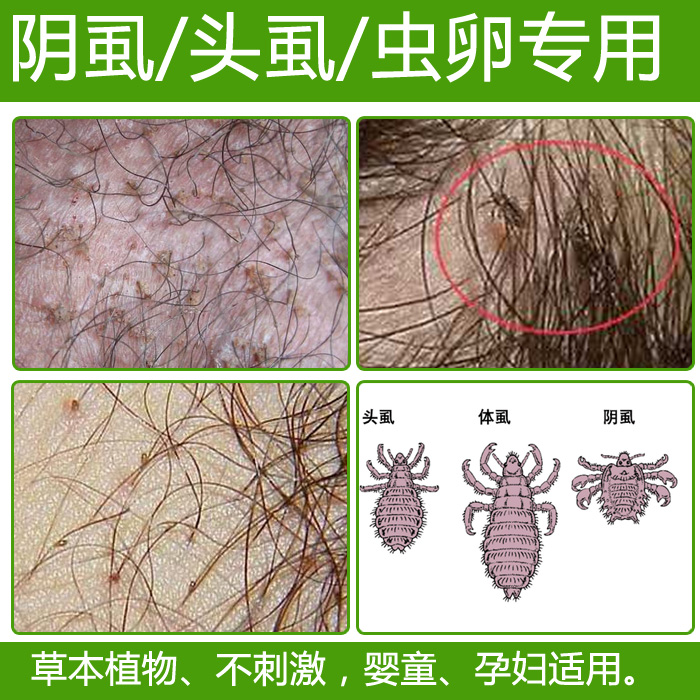去虱子除阴虱私处虱卵药成人男士用儿童喷雾洗液阴虱净喷剂奇痒阴|ruв категории туалетные чище/санитарно - гигиенических салфеток/бумага/Ароматерапия, дегельминтизация товаров, зооциды/инсектициды - от Buy2taobao.com для оказания профессиональной услуги покупки агента Taobao