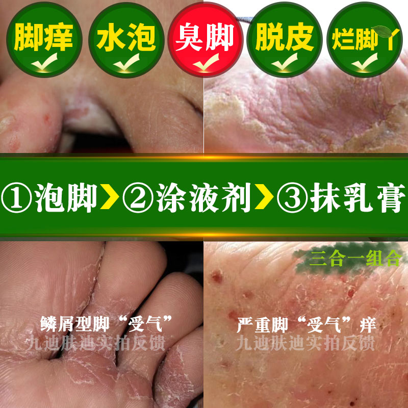 脚汽严重药高肤痒正品烂泡脚的药包治臭女儿童除臭专注小孩手脚痒在类目 洗护清洁剂/卫生巾/纸/香薰, 洗发沐浴/个人清洁, 身体护理, 其它身体护理产品中 - 来自Buy2taobao.com提供专业的淘宝代购服务