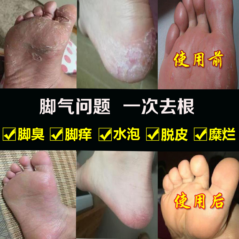 治疗腳氣噴劑烂腳丫噴雾真菌感染止痒脱皮水泡型殺菌正品去根藥膏在类目 本地化生活服务, 健康服务, 足浴/洗浴/按摩中 - 来自Buy2taobao.com提供专业的淘宝代购服务