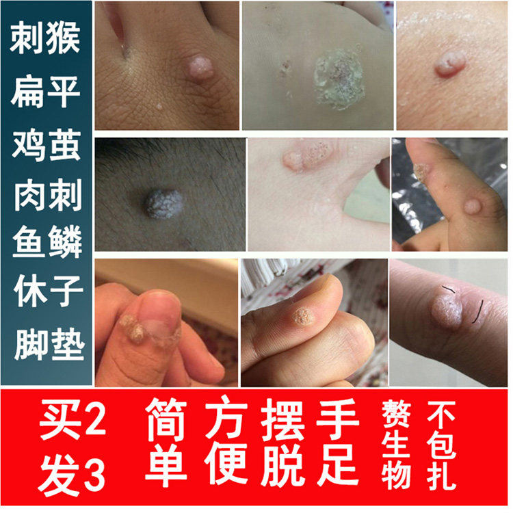 秋绿去除猴子刺猴肉刺鸡茧眼膏贴手足脚垫赘生物跖尤鱼鳞痣特傚膏在类目 洗护清洁剂/卫生巾/纸/香薰, 洗发沐浴/个人清洁, 身体护理, 其它身体护理产品中 - 来自Buy2taobao.com提供专业的淘宝代购服务