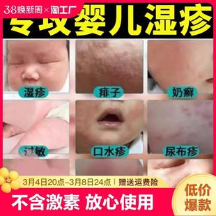 湿疹膏婴儿专用儿童宝宝，湿疹口水疹无激素，干性保湿秋冬面霜身体乳