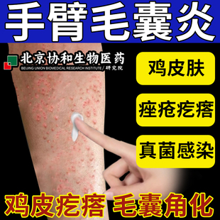 手臂毛囊炎胳膊上长疙瘩药膏真菌感染去鸡皮肤痤疮祛痘止痒LE