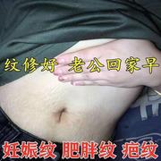 去妊娠纹肚c子妊辰纹产后消除大腿肥胖纹K生长纹预防紧致产后修复