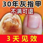 灰指甲液脱甲膏去除增厚抑菌脚趾专用非根治特效治疗药