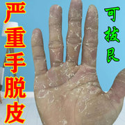 手脱皮严重脱皮专用药膏真菌//感染手指干燥起皮蜕皮皲裂护手霜