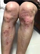 大腿银屑病牛皮专用藓廯鲜癣药膏杀菌体，止痒外用治疗皮肤银屑特效