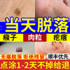 扁平疣面部去疣跖疣寻常疣丝状脖子去除膏瘊子净鸡眼乳膏湿疣肉粒