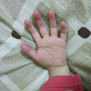 宝妈儿童手掌蜕皮手脱皮膏手指头上起皮干燥爆皮手掌手脚掉皮
