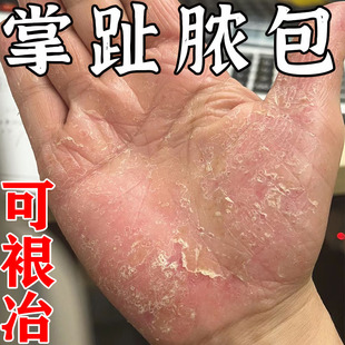 掌趾脓包治疗手脚脓包角化病掌跖脓包干裂手蜕皮发痒真菌感染专用