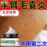 手臂毛囊炎专用鸡皮肤角化长痘痘小疙瘩胳膊上膏药贴的真菌感染