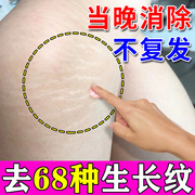 肥胖纹修复霜消除去肥胖纹，去除产后妊娠纹大腿纹生长纹路淡化神器
