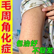 毛周角化症药膏去除鸡皮肤，疙瘩毛囊角化角质，身体乳去腿上手臂神器