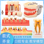 牙齿模型 牙科种植六倍大龋齿病理修复正畸 假牙口腔医院教学摆件
