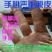 鹅掌风特效脚手癣干裂脱皮真菌感染手部外用止痒抑菌膏汗疱疹药膏