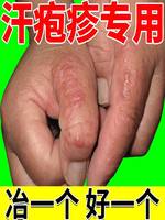 手脱皮鹅掌风真菌感染手癣脚癣手，干裂水泡汗泡克星，汗泡诊止痒膏