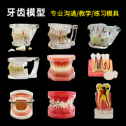 牙科牙齿模型假牙模型具可拆卸医患沟通口腔教学练习修复解刨摆件