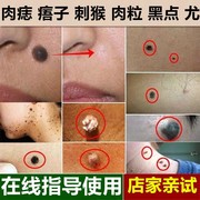 点痣膏无痕药水脸部祛痣膏点痦子取去痣黑痣不留疤专用