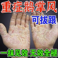 鹅掌风特效脚手癣干裂脱皮真菌感染手部外用止痒抑菌膏汗疱疹药膏