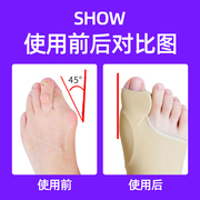 脚趾矫正器拇指外翻分离器女保护趾头纠正带脚型护理脚骨分趾器