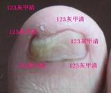 独家【123】灰甲清 ！封包治疗灰指甲 高效 方便 快速 千人验证