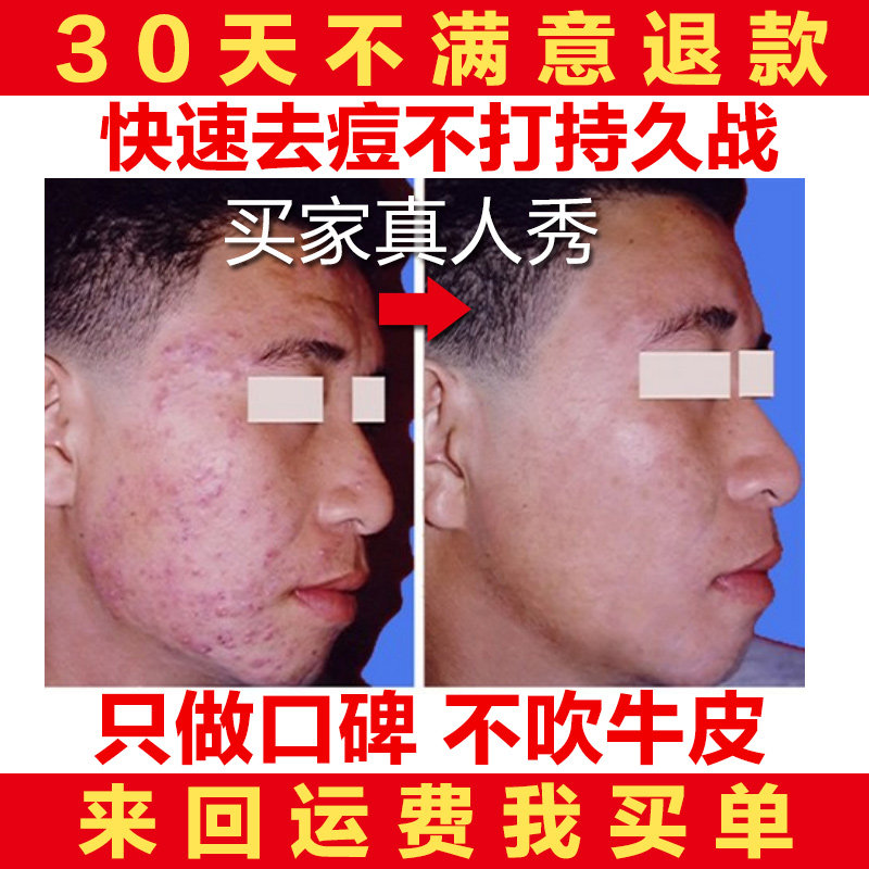 男士祛痘产品前五强抗痘去痘印精华粉刺消炎修复青春痘痘急救痤疮