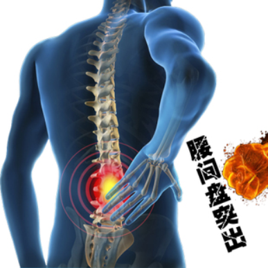陶氏贴膏 腰间盘突出贴膏药特效腰肌劳损腰间