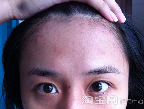 迟来的报告~黛依美雷涛祛痘效果好!_春冬