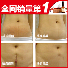 ANU阿奴去妊娠纹复方精油 产后去除消除妊娠纹疤痕修复
