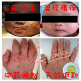 明健牌 成人严重湿疹 皮炎 瘙痒 婴儿股癣 奶癣 手中癣 脚气