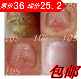 109灰指甲专用特效药 脚气特效药 亮甲 灰指甲药超强效果