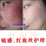 强烈推荐：XUESU雪夙舒敏去红伴侣套(修复红血丝,敏感强效组合)