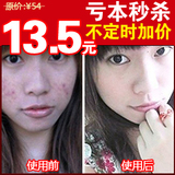 芭芭卡伦祛疤去痘印精油 去疤痕祛痘印烫伤凸凹疤痕疙瘩精油