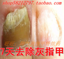 足宝7天去除灰指甲 软甲膏 灰指甲专用特效药 还你亮甲融甲膏
