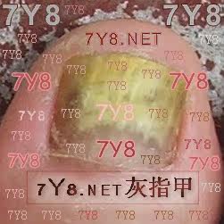 【7Y8 NET指甲水】 7Y8灰指甲水 灰指甲药灰甲水还你亮甲靓美甲